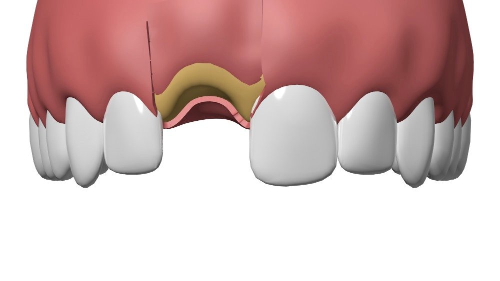 Implants dentaires Nimes