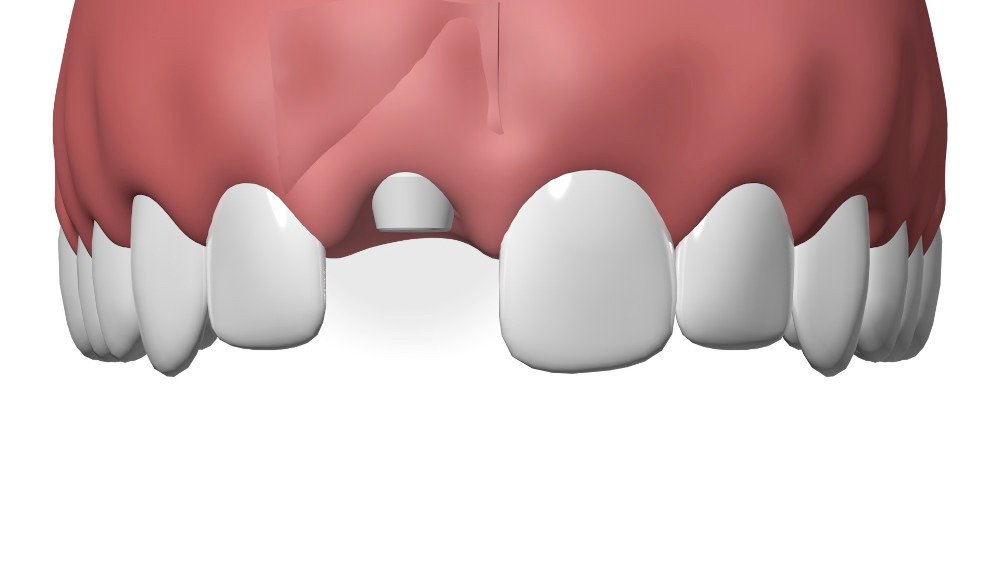 Implants dentaires Nimes