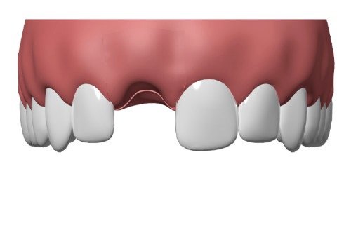 Implant dentaire nimes