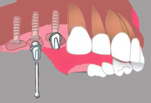 Implants dentaires Nimes