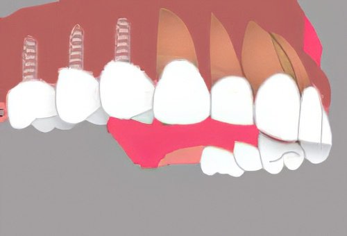 Implants dentaires Nimes