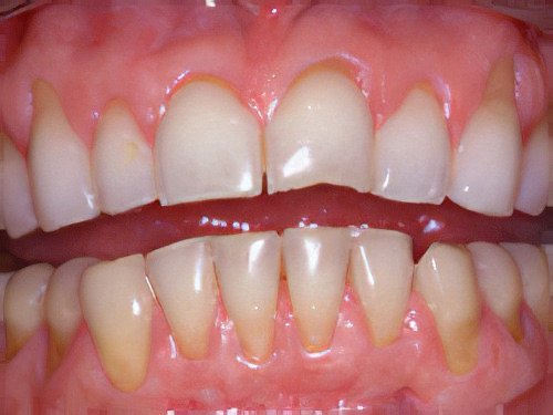 Eclaircissement dentaire 1