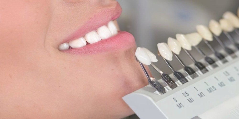 Sourire esthétique